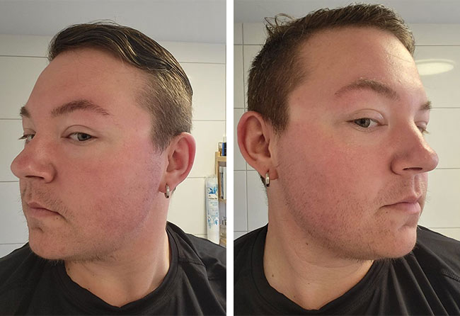 Vorher Saphir Barttransplantation mit 4000 Grafts bei Patient Ryan B