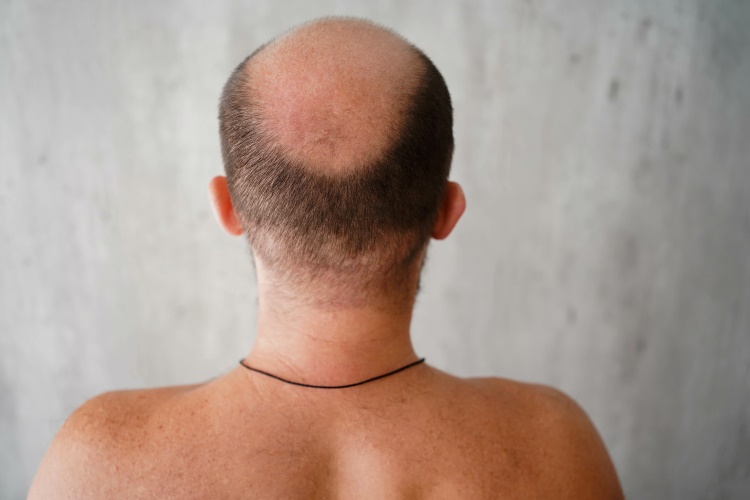 Hinterkopf eines Mannes mit Glatze