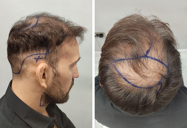 Max Coga vor der DHI Haartransplantation mit 3250 Grafts