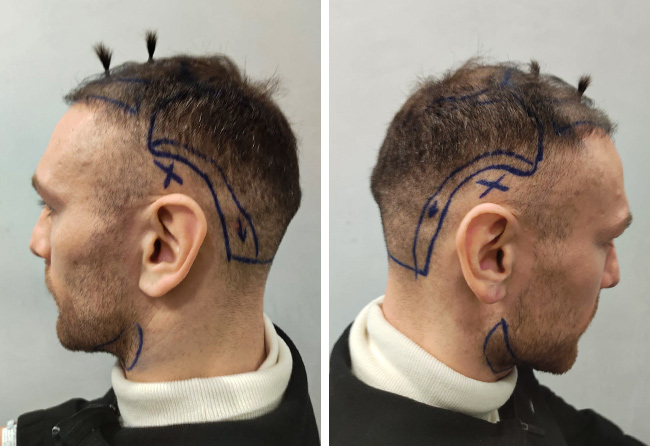 Kerim Engizek vor seiner Haartransplantation