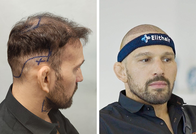 Max Coga vor und nach seiner NEO FUE DHI Haartransplantation im Vergleich