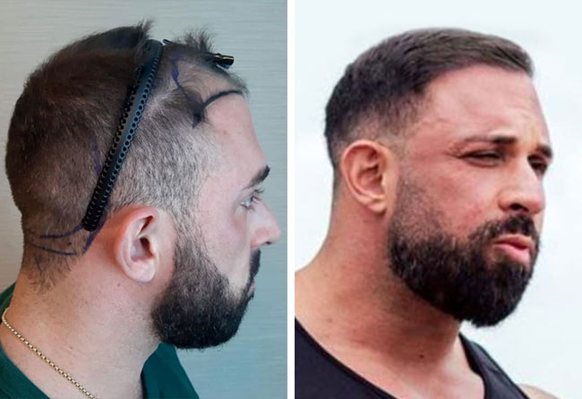 Vorher Nachher Vergleich von Kevin Wolter vor und nach seiner Haartransplantation