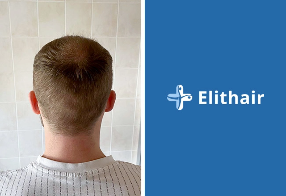 Spenderbereich von Elithair Patienten nach der Haartransplantation