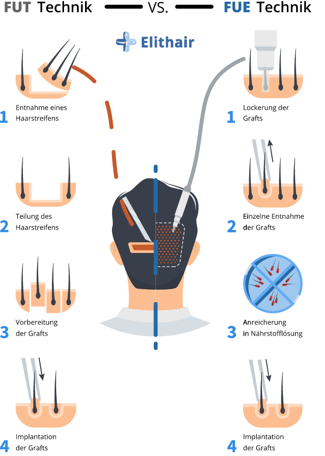 Infografik zum Vergleich der FUT und FUE Methode zwecks Entnahme der Haarfollikel bei der Haartransplantation