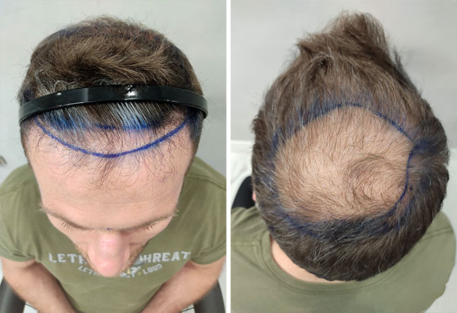 Stephan Pütz vor der Haartransplantation
