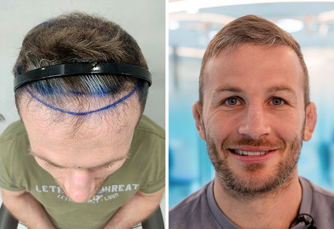 Stephan Pütz vor und nach seiner DHI Haartransplantation mit 5700 Grafts im Vergleich