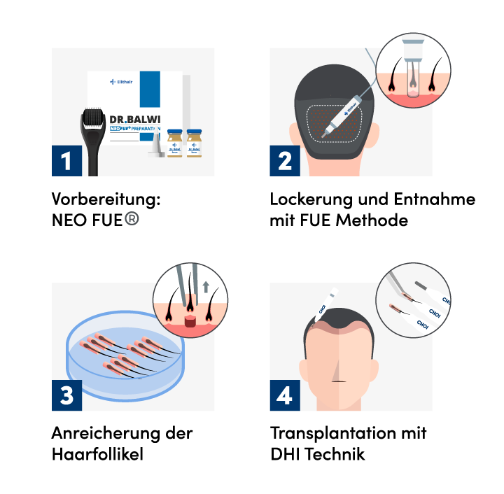 Infografik der 4 Schritte für die DHI Haartransplantation