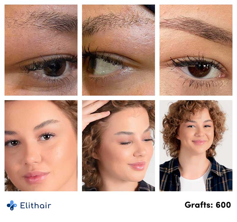 Verlauf der Augenbrauentransplantation im Vorher Nachher Vergleich von Elithair Patientin mit 600 Grafts