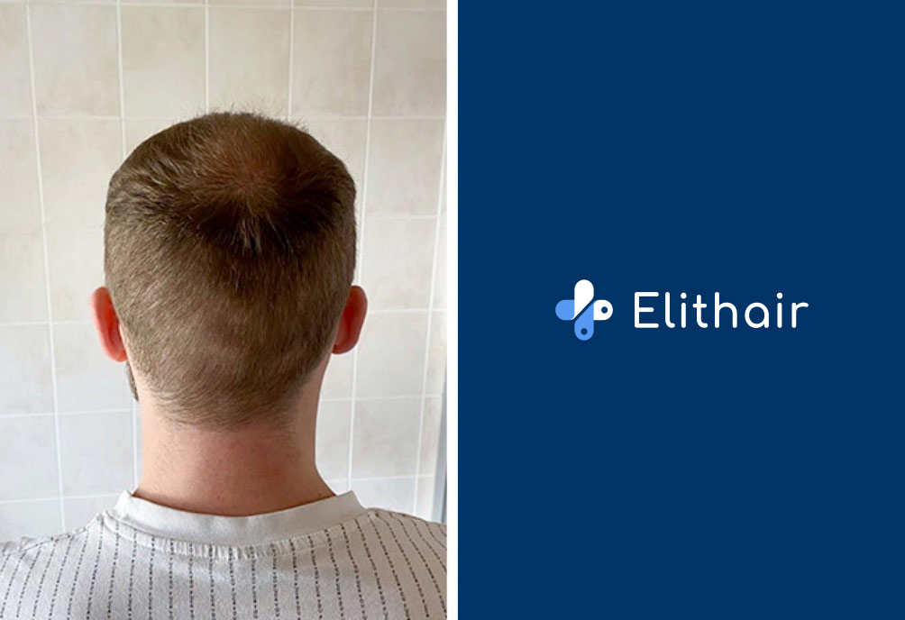 Der Spenderbereich von Elithair Patienten nach der Haartransplantation