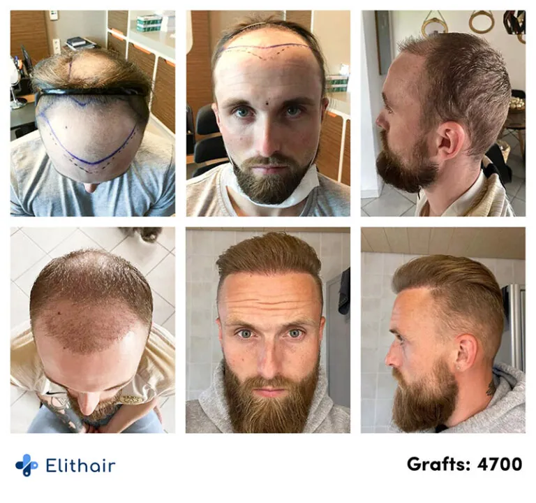 Patient von Elithair zeigt seinen Vorher-Nachher Saphir Haartransplantation Verlauf mit 4700 verpflanzten Grafts