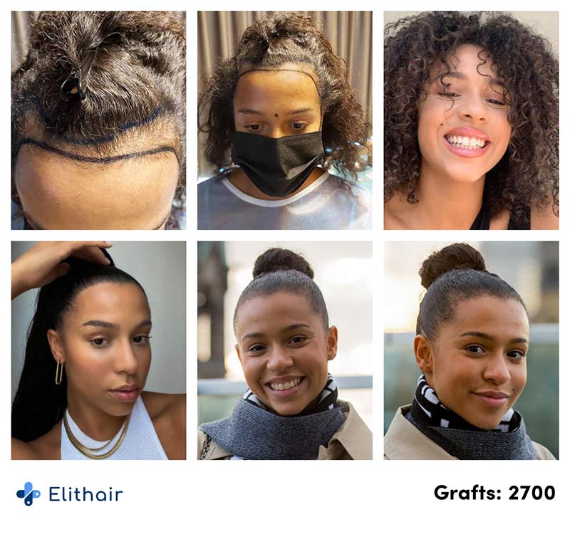 Elithair Patientin Melissa zeigt Ihren Vorher Nachher Verlauf bei der Haartransplantation für Frauen mit 2700 Grafts