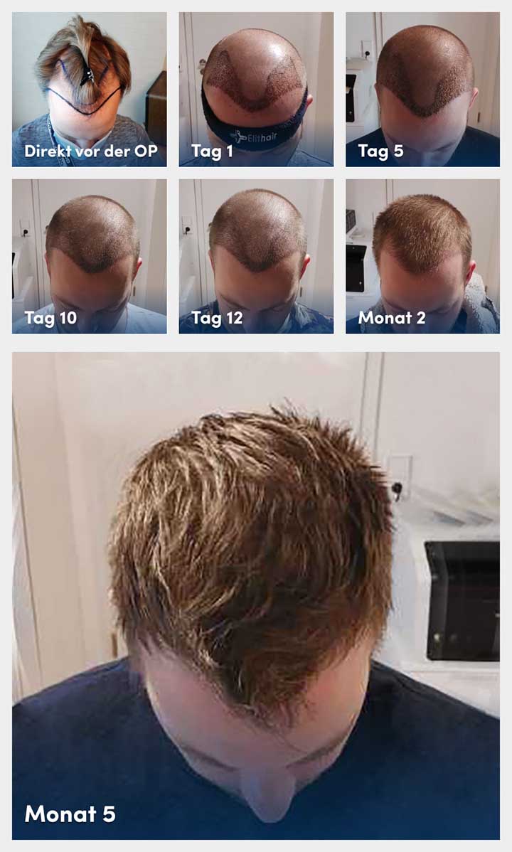 Der Heilungsverlauf vor, während und nach der Haartransplantation anhand von 7 Phasen