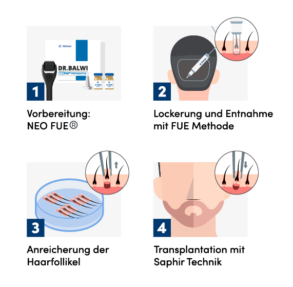 Infografik der 4 Schritte für die Barttransplantation bei Elithair
