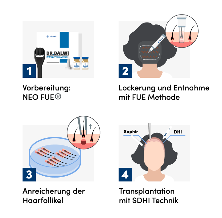 Infografik zum Ablauf der 4 Schritte für die Haartransplantation bei Frauen