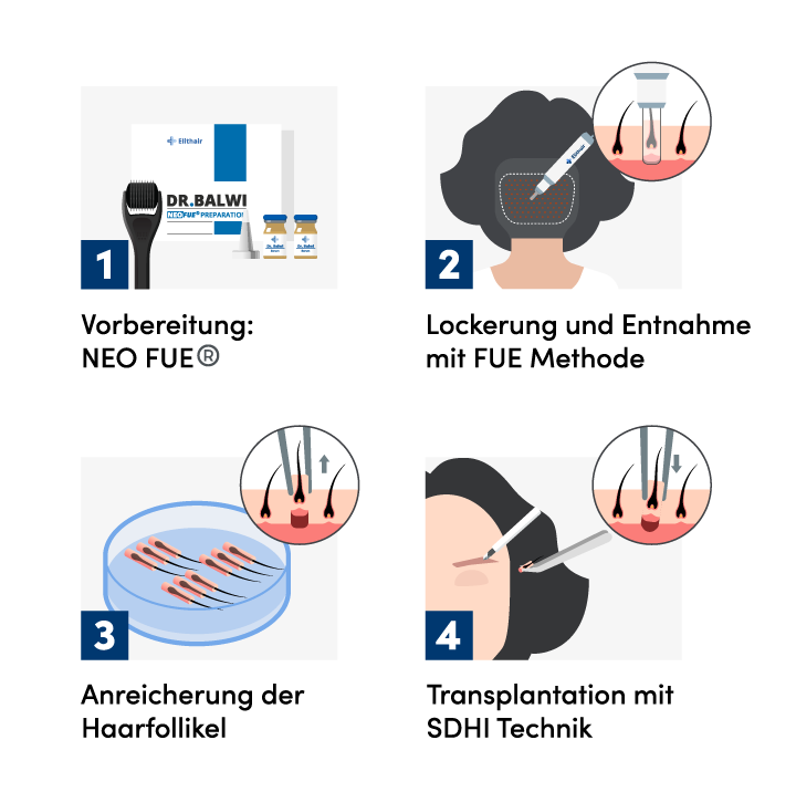 Infografik zum Ablauf der Augenbrauentransplantation anhand von 4 Schritten