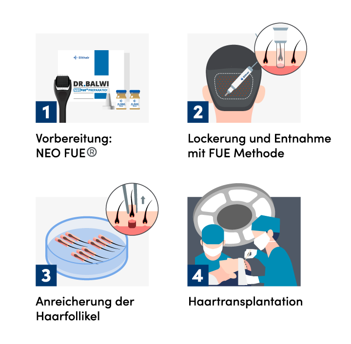Infografik der 4 Schritte für die Entnahme der Grafts aus dem Spenderbereich mit der FUE Haartransplantation