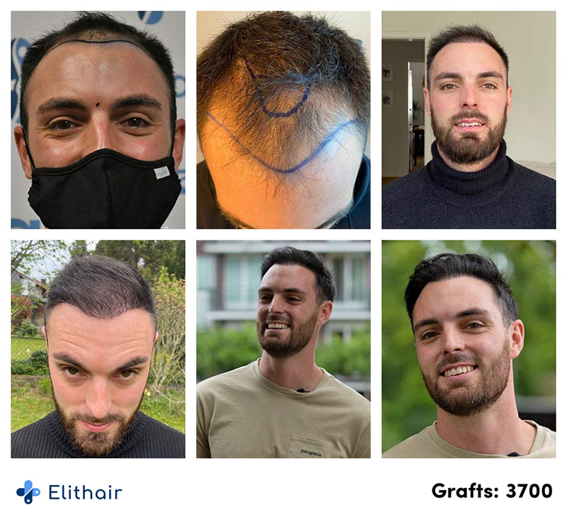 Haartransplantation Türkei Experten In Istanbul Elithair