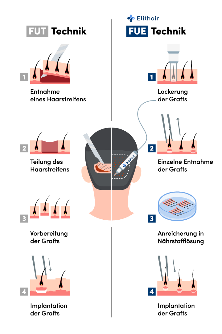 Infografik zum Vergleich der FUT und FUE Technik zwecks Entnahme der Haarfollikel aus dem Spenderbereich bei der Haartransplantation