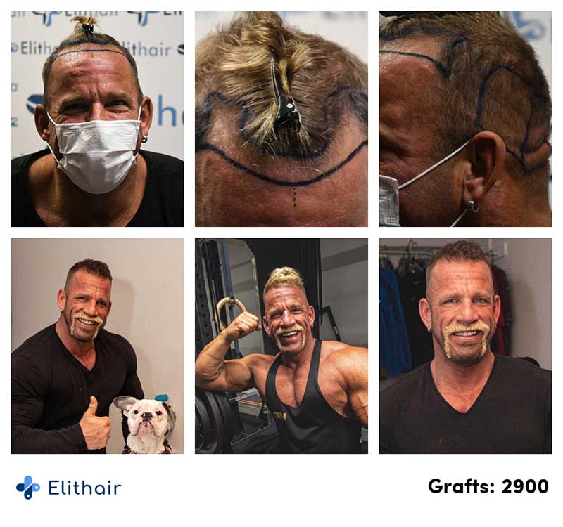 Vorher Nachher Perkutan Haartransplantation Vergleichsbilder von Patient Hollywood Matze mit 2900 Grafts