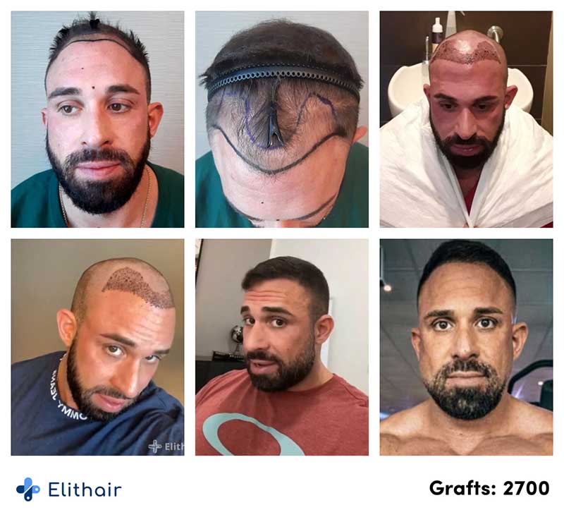Vorher Nachher Verlaufsbilder der Perkutan Haartransplantation von Patient Kevin Wolter mit 2700 Grafts