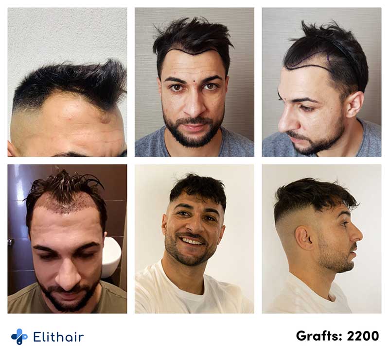 Saphir Haartransplantation Vorher Nachher Vergleich Patient Osmani mit 2200 Grafts