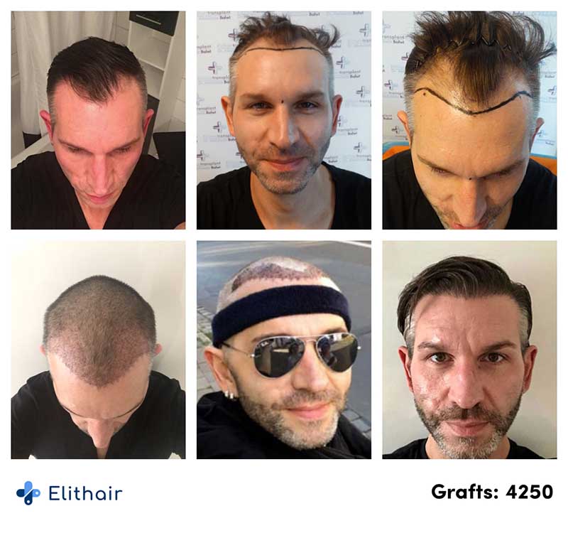 Vorher Nachher Vergleich der Saphir Haartransplantation von Elithair Patient Thomas mit 4250 Grafts