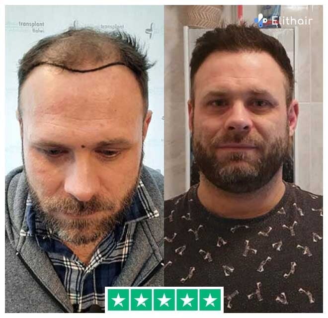 Das Bild zeigt Michael, einen Elithair-Patienten, vor und nach seiner Haartransplantation mit 3700 Grafts