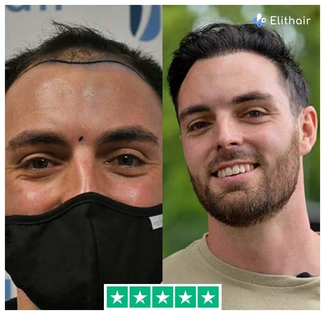 Das Bild zeigt Sebastian, einen Elithair-Patienten, vor und nach seiner Haartransplantation mit 3700 Grafts
