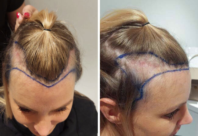 Vorher DHI Haartransplantation mit 3100 Grafts bei Patientin Doreen Seidel