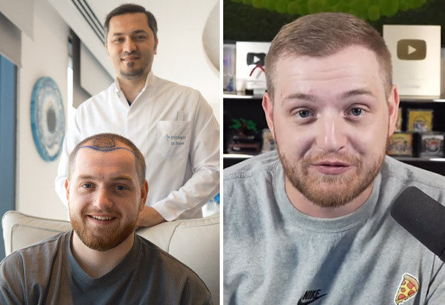 Vorher Nachher DHI Haartransplantation mit 3400 Grafts von Patient Trymacs