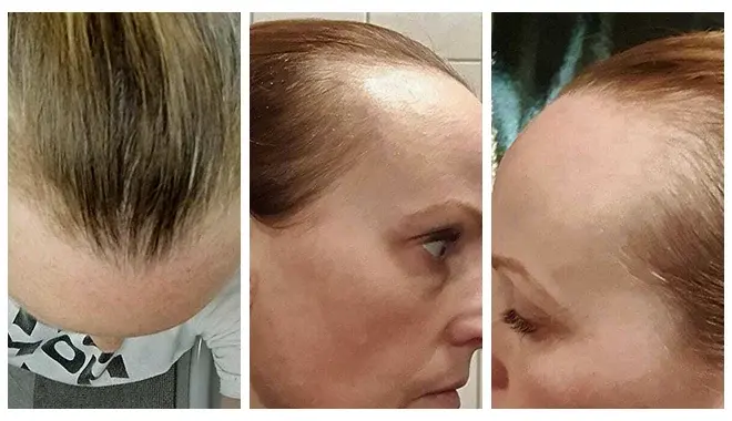 Bild zeigt, den Haarausfall bei einer Frau vor der Haartransplantation an den Geheimratsecken