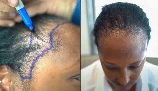 Bild zeigt, eine Patienten von Elithair bei der Einzeichnung der Haarlinie für die Haartransplantation bei Frauen