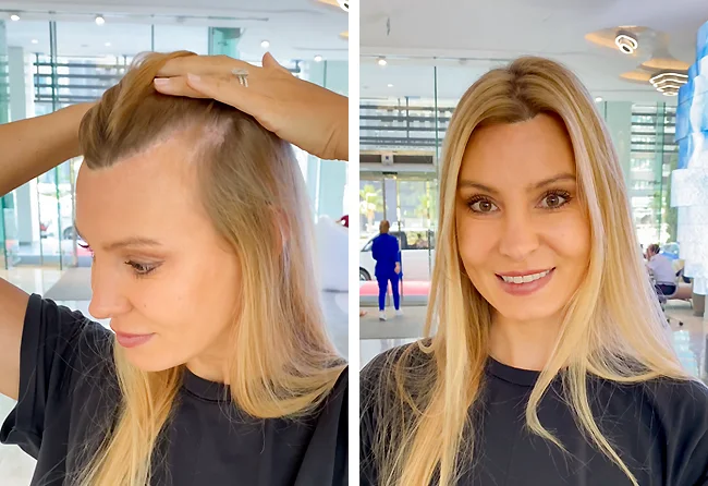 Bild zeigt, dass Vorher Nachher Ergebnis bei der Haartransplantation für Frauen