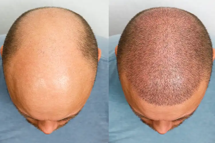 Vorher-Nachher-Bild eines Patienten nach einer Haartransplantation