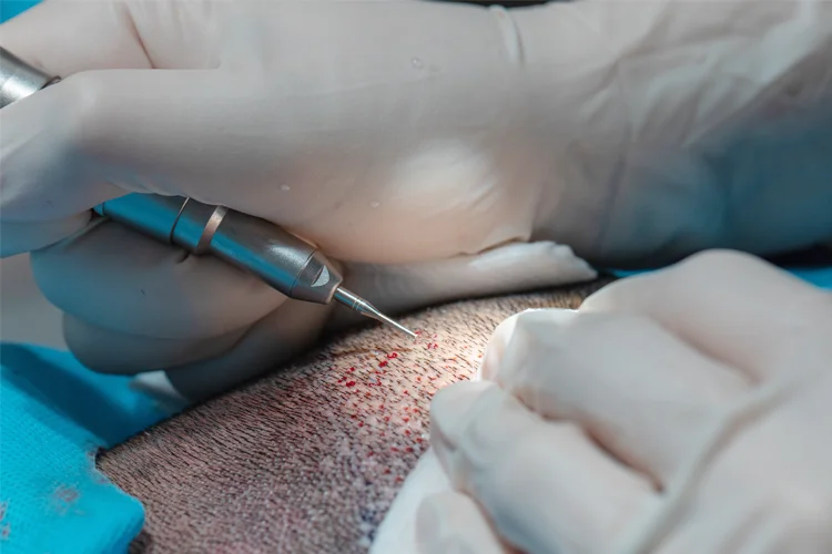 Bei einer Haartransplantation werden Grafts eingefügt
