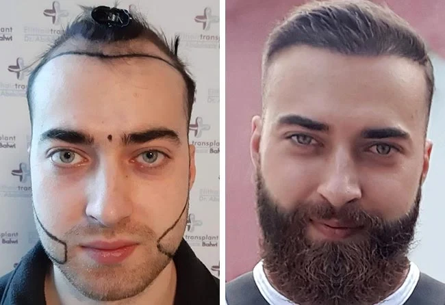 Vorher-Nachher-Ergebnis einer Haartransplantation bei Elithair