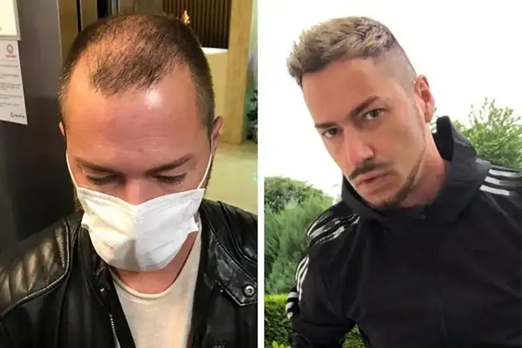 Vorher-Nachher-Bild von Elithair-Patient André O. nach einer Haartransplantation
