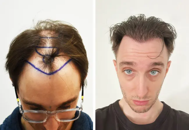 Vorher-Nachher-Bilder von Daniel S. vor- und nach seiner DHI-Haartransplantation bei Elithair