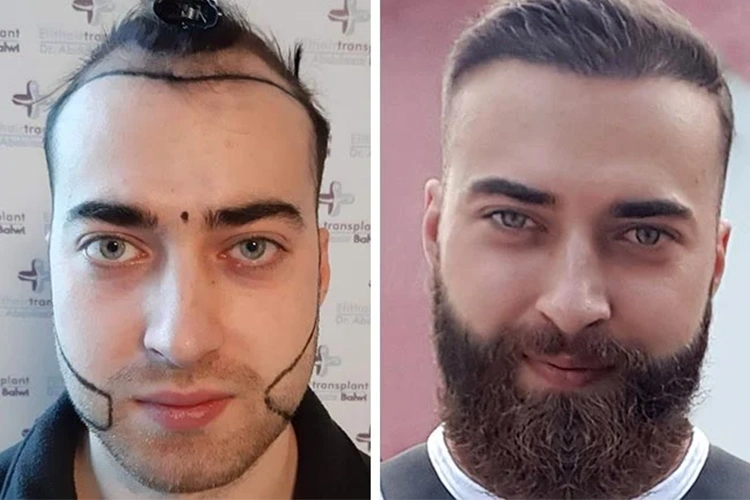 Vorher-Nachher-Darstellung des Elithair-Patienten Haariger Andre nach einer Haartransplantation – zeigt das erfolgreiche Ergebnis mit deutlich vollerem Haar und neuem Selbstbewusstsein.
