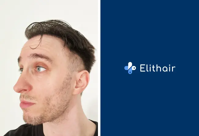 Nachher-Ergebnis der Haartransplantation von Daniel S. bei Elithair
