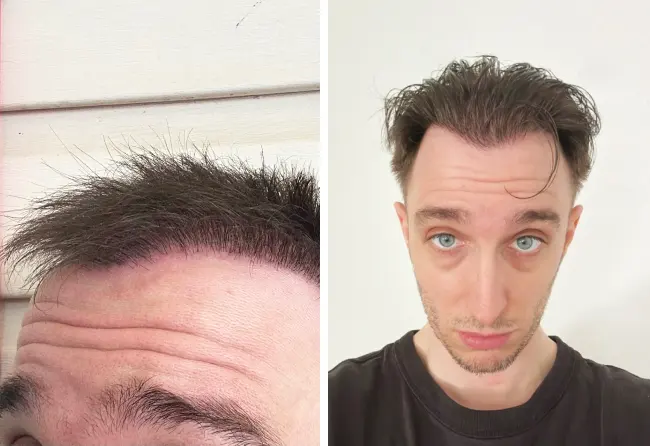 Vergleich der Ergebnisse einer Haartransplantation bei Elithair nach 6 Monaten und nach 12 Monaten