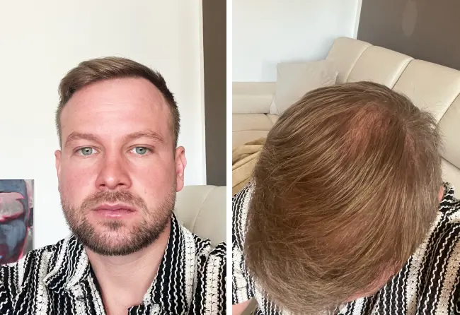 Ergebnis von John B. nach seiner DHI-Haartransplantation bei Elithair