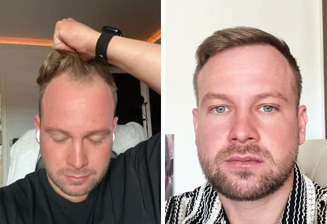 Vorher-Nachher-Bilder von John B. nach seiner DHI-Haartransplantation bei Elithair