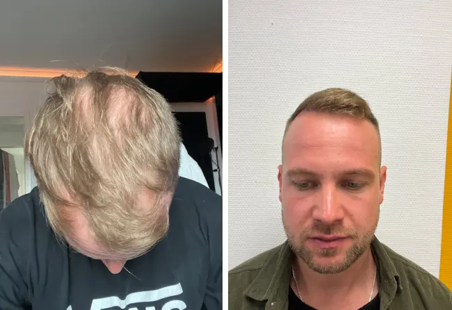 Vorher-Nachher-Bilder von John B. mit kahler Tonsur vor und vollem Haar nach seiner Haartransplantation bei Elithair