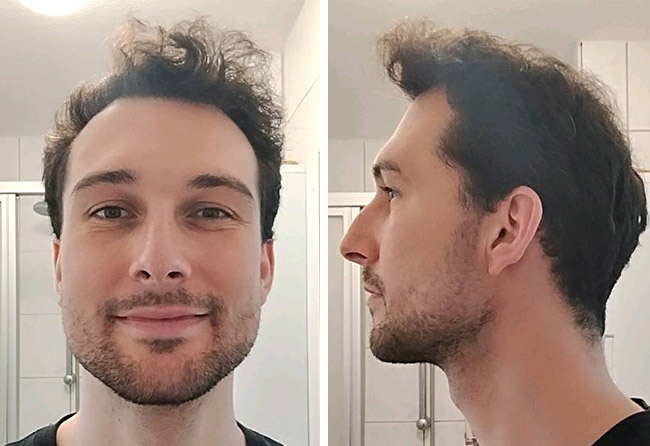 Nachher-Ergebnis von Maximilian B. nach seiner DHI-Haartransplantation bei Elithair