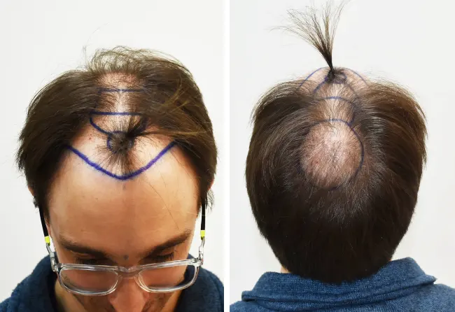 Vor der Operation – Planungsphase der Haartransplantation von Daniel S. bei Elithair