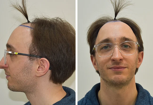 Vorher DHI Haartransplantation mit 5300 Grafts bei Patient Daniel S.