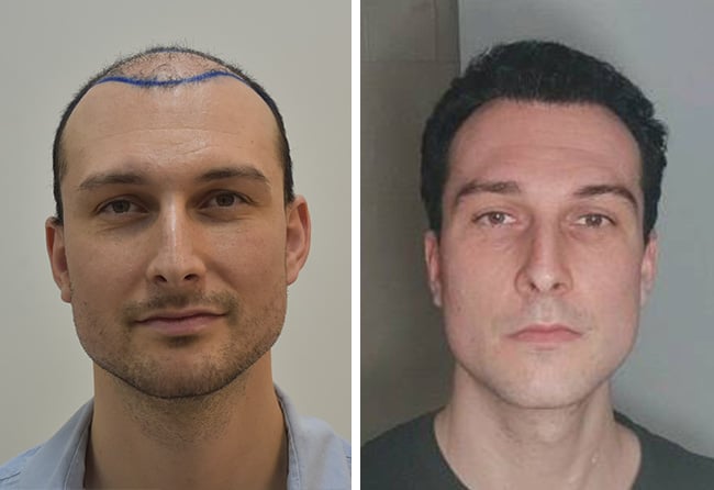 Maximilian B. vor- und nach seiner DHI-Haartransplantation bei Elithair
