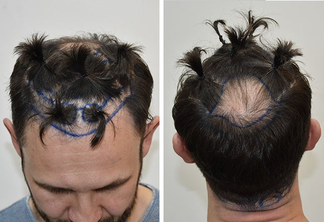 OP-Planung bei Alexander B. vor der Haartransplantation bei Elithair – markierte Zonen im Bereich der Geheimratsecken und Tonsur