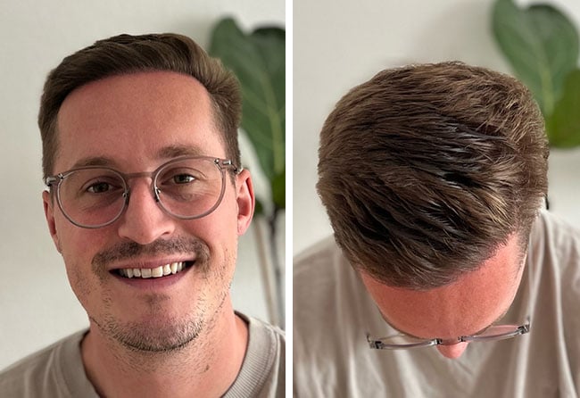 Endergebnis der Haartransplantation bei Christopher L.